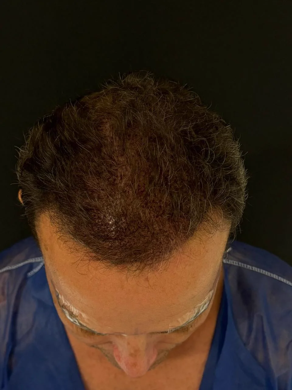 Depois do transplante capilar - resultado 5