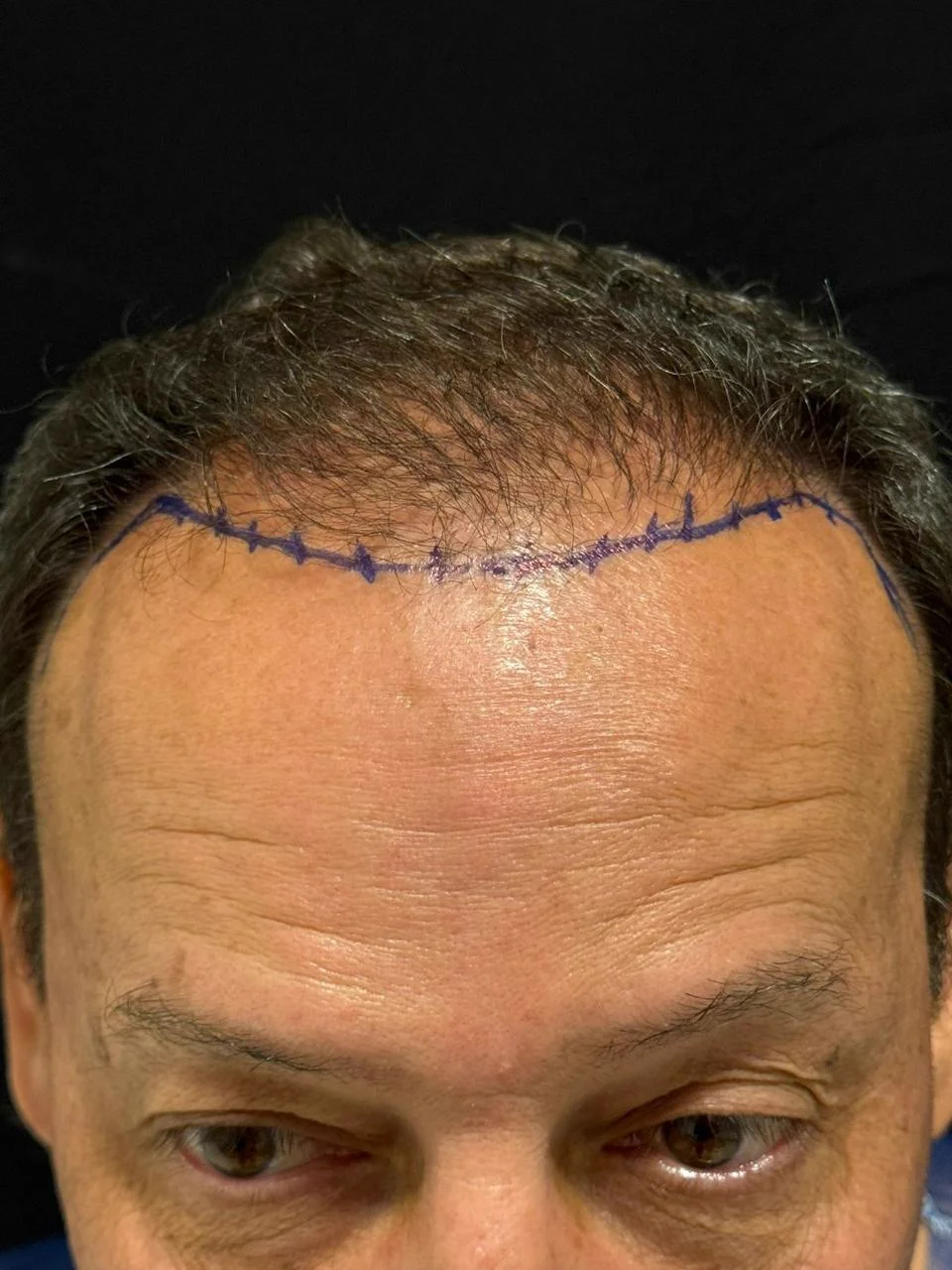 Antes do transplante capilar - resultado 5